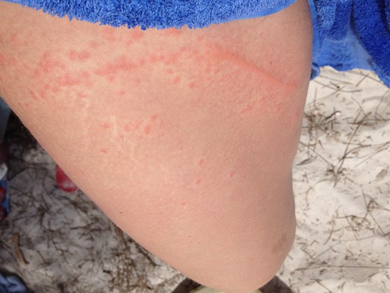 bluebottle stings on thigh Sydney